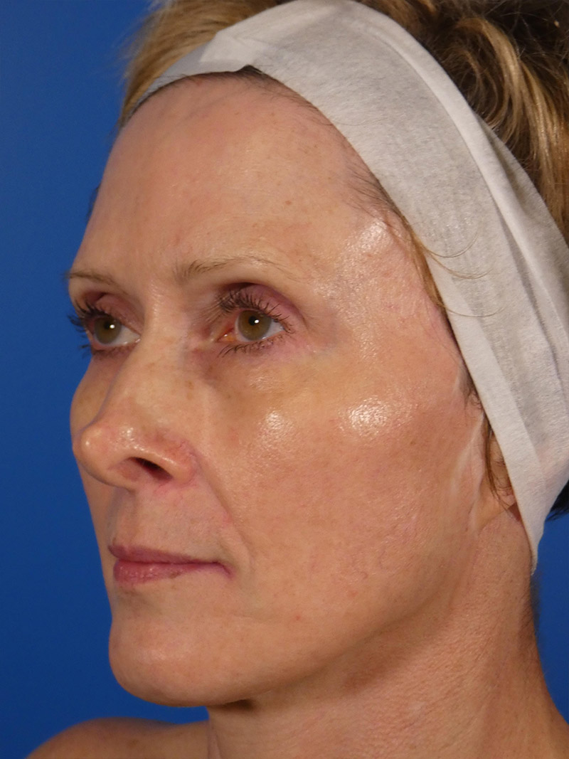 Ipl Sun Spots Before and After | Plastic Surgery Associates of Valdosta